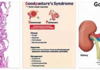 Goodpasture Syndrome